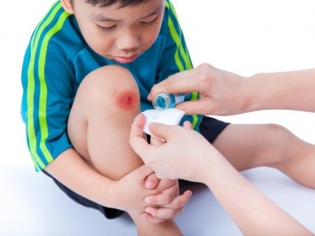 Làm thế nào để xử lý vết bầm tím, vết thương cho trẻ nhỏ