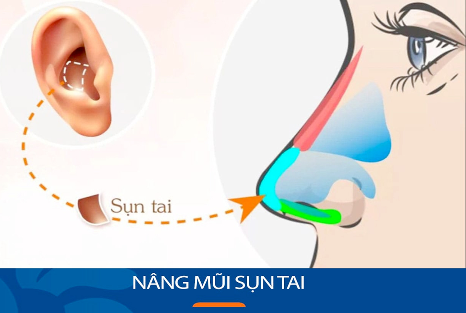 Nâng mũi xong bao lâu thì hết sưng bầm và gom dáng? Quy trình phục hồi chuẩn y khoa