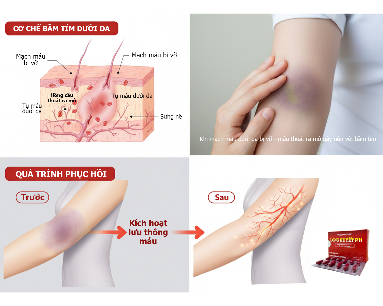 Bầm tím không đơn giản là bầm tím - Khi bên trong đang “chảy máu”