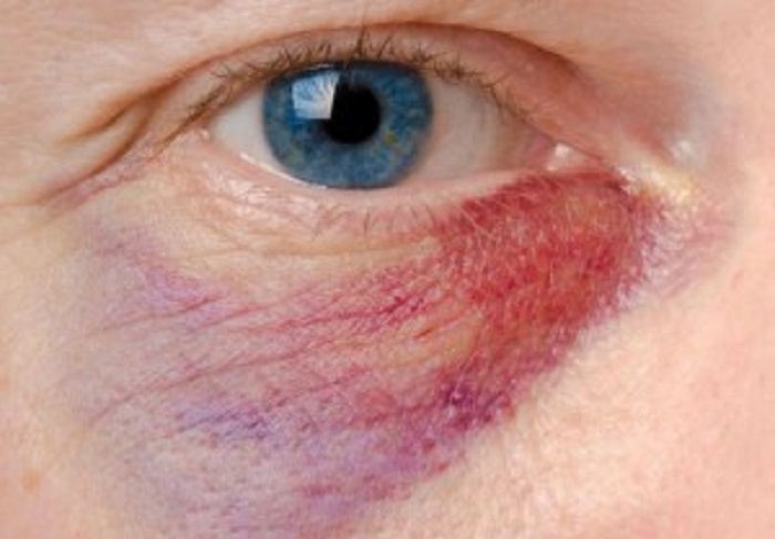 5 Cách làm tan máu tụ ở mí mắt hiệu quả bạn nên biết - Long huyết PH tan bầm tím, giảm sưng đau
