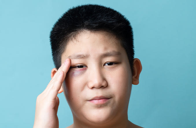 Bầm tím mắt ở trẻ nhỏ