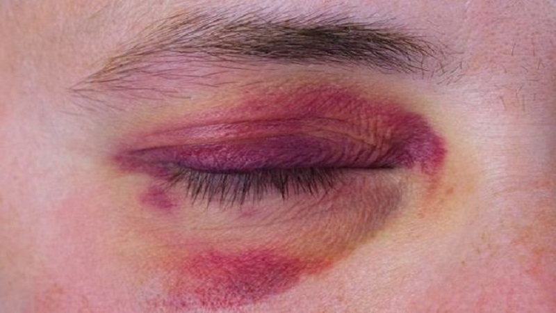 Biện pháp chữa bầm tím mắt tại nhà nhanh nhất