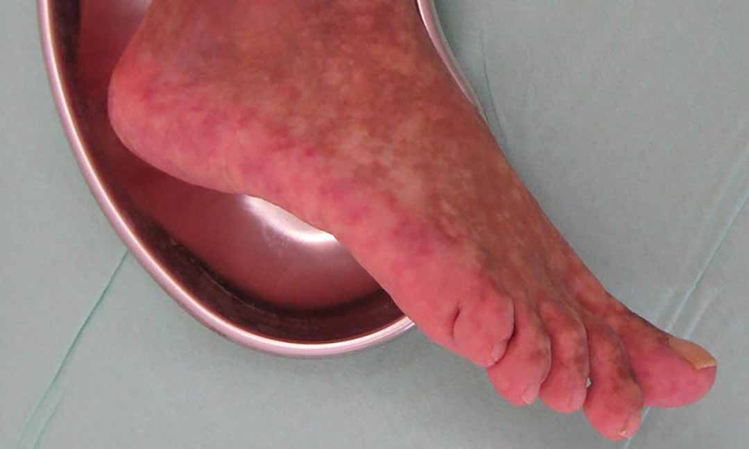 Chân bị bầm tím do lupus ban đỏ